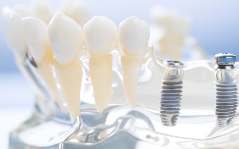 Implants dentaires modernes pour un sourire parfait, illustrant les options avancées de dentisterie esthétique à Boucherville.